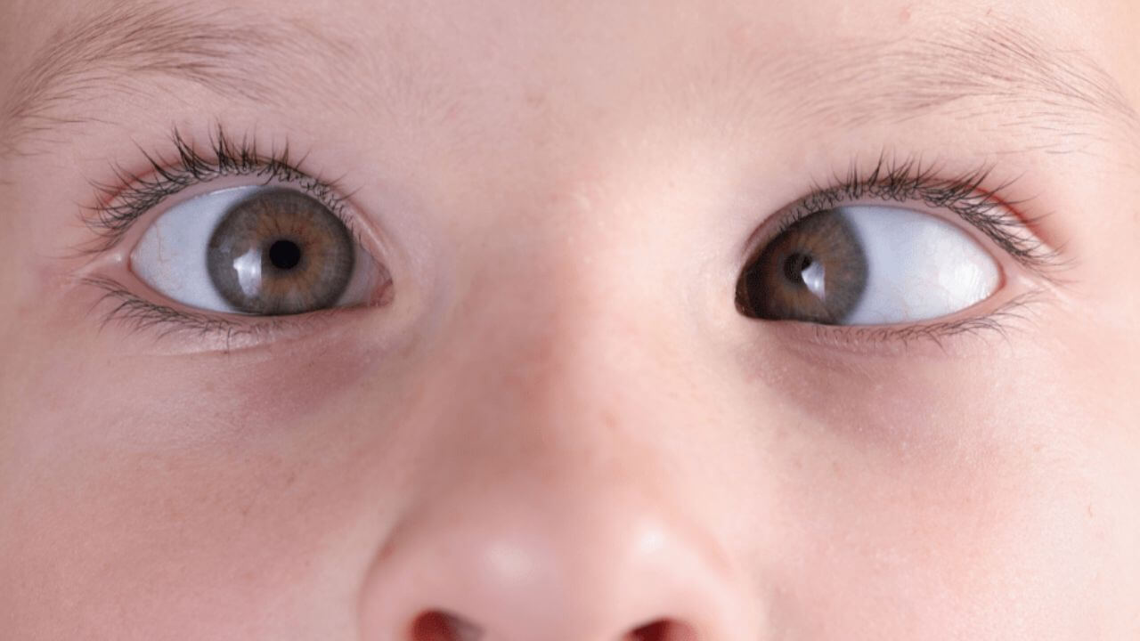 Squint Eye in Babies: Understanding Vision Problems and Eye Health Issues